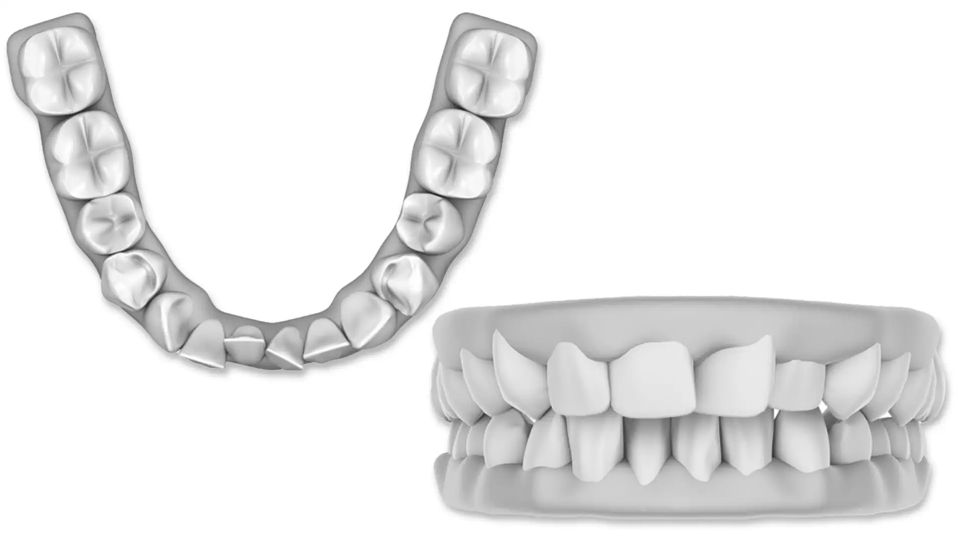 Affollamento Dentale