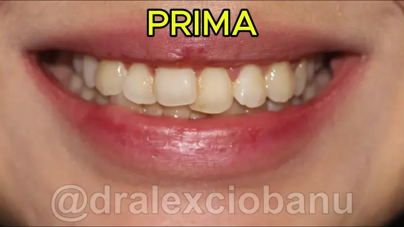 Caso Clinico Affolamento Dentale - Prima - Dopo