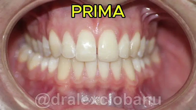 Caso Clinico Diastema Prima - Dopo