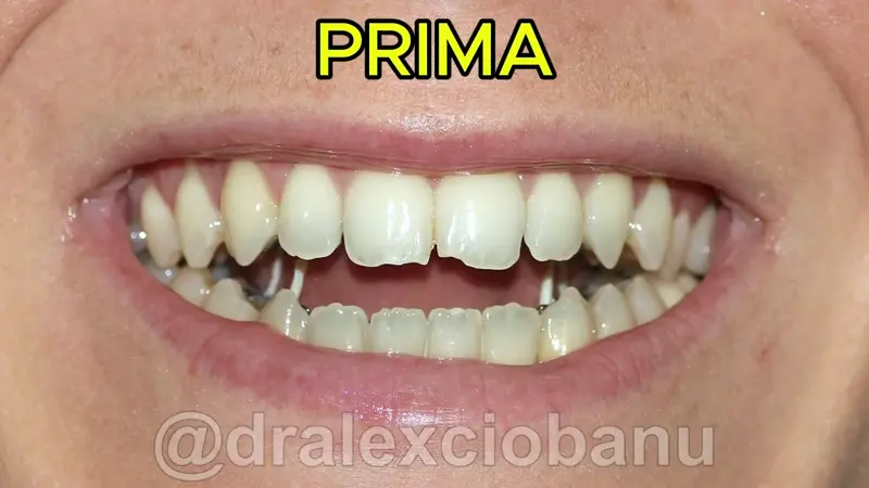 Caso Clinico Morso Aperto Prima - Dopo