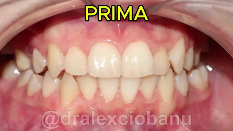 Caso Clinico Morso Incrociato Prima - Dopo