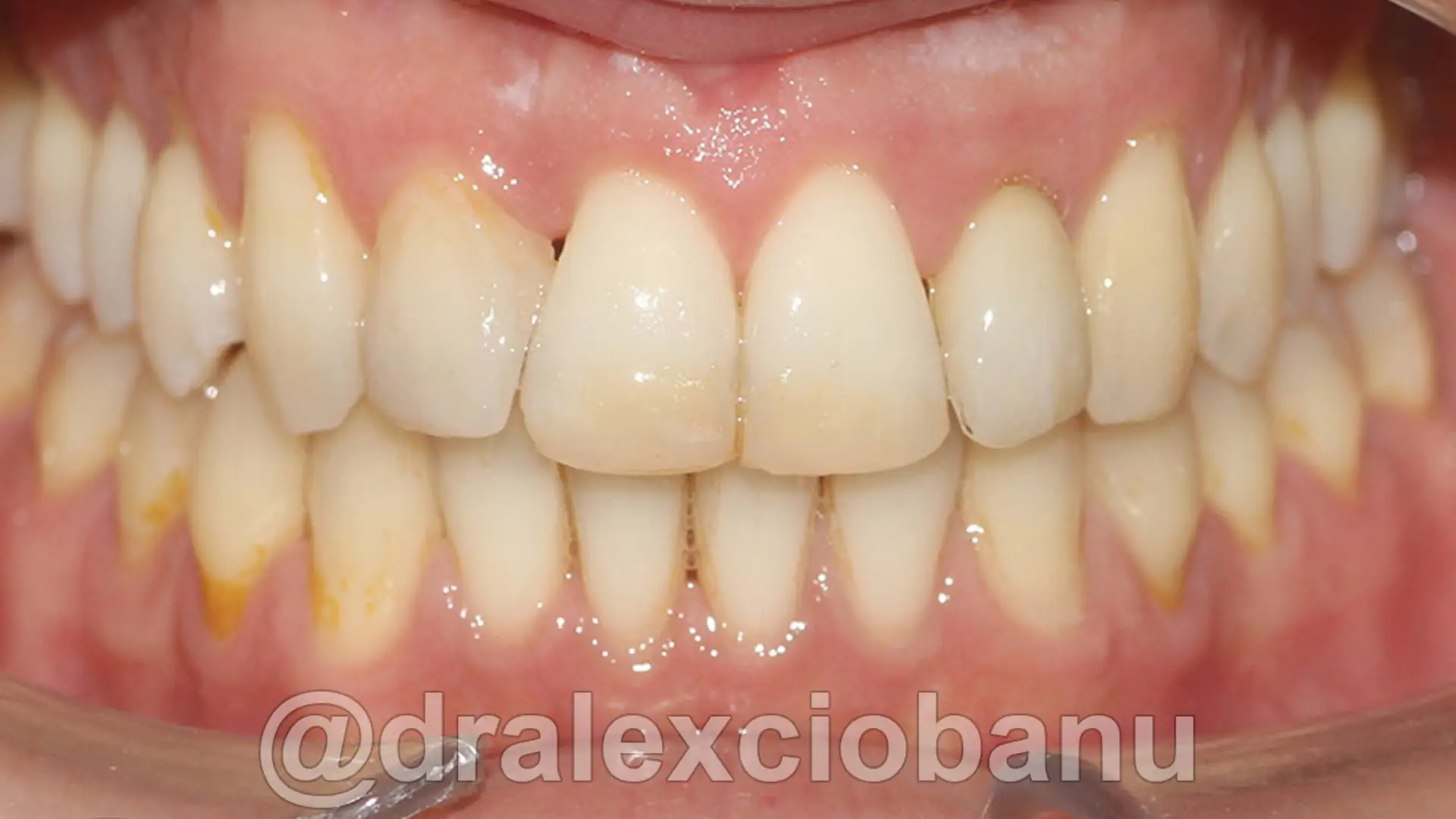 Caso Clinico Morso Inverso Bilaterale - Crossbite Dopo