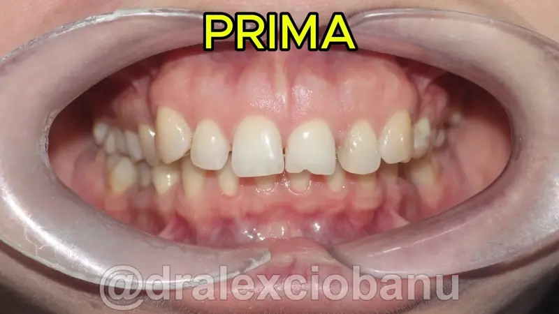 Caso Clinico Morso Profondo - Prima Dopo