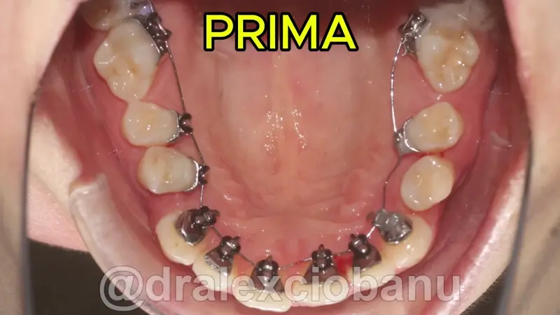 Caso Clinico Morso Profondo - Prima Dopo