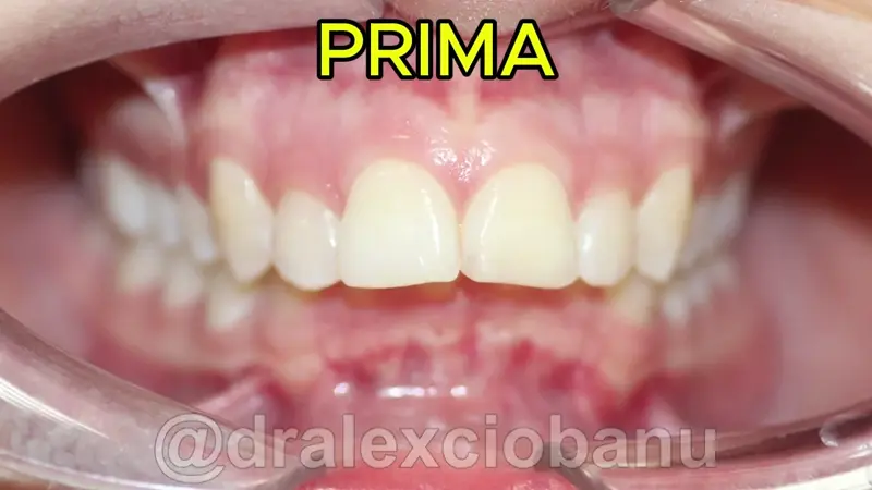 Caso Clinico Morso Profondo Prima - Dopo