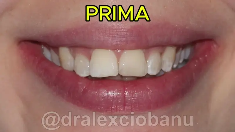 Caso Clinico Overbite Sovramorso Prima - Dopo