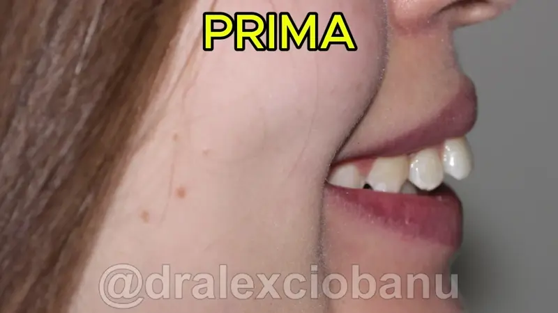Caso Clinico Overbite Sovramorso Prima - Dopo