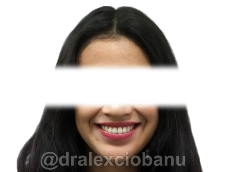 Caso clinico AFFOLAMENTO DENTALE - 1 Dopo