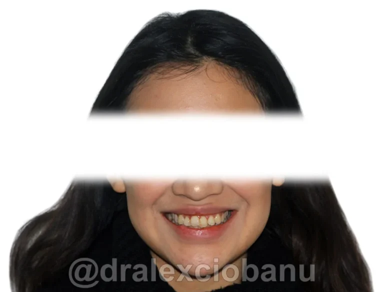 Caso clinico AFFOLAMENTO DENTALE - 1 Prima