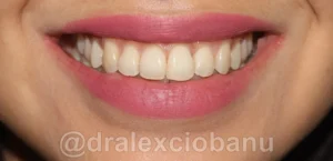 Caso clinico AFFOLAMENTO DENTALE dopo