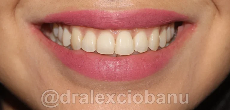 Caso clinico AFFOLAMENTO DENTALE dopo