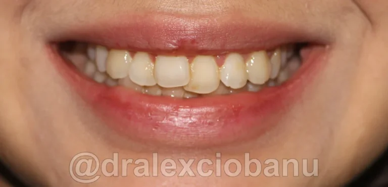 Caso clinico AFFOLAMENTO DENTALE - 2 Prima