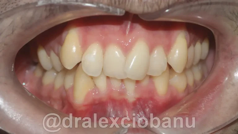 Caso clinico AFFOLAMENTO dentale PRIMA