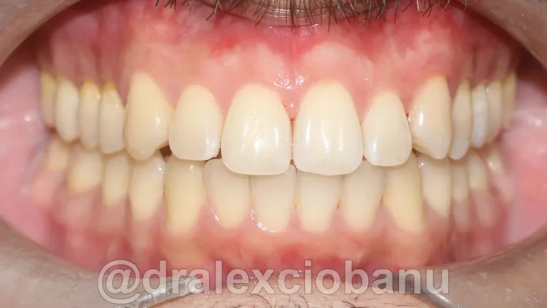Caso clinico - Affolamento Dentale 1 - Dopo
