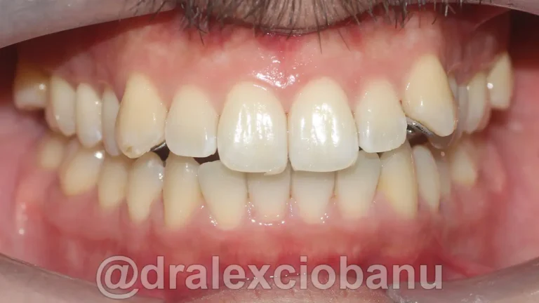 Caso clinico - Affolamento Dentale - Prima