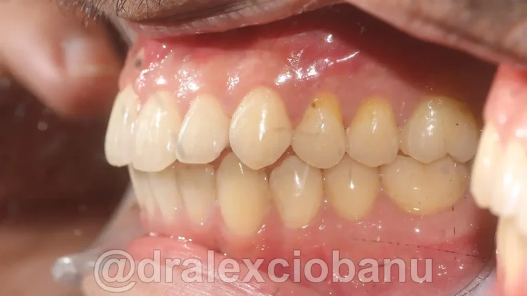 Caso-clinico-Affolamento-Dentale-2-Dopo-1