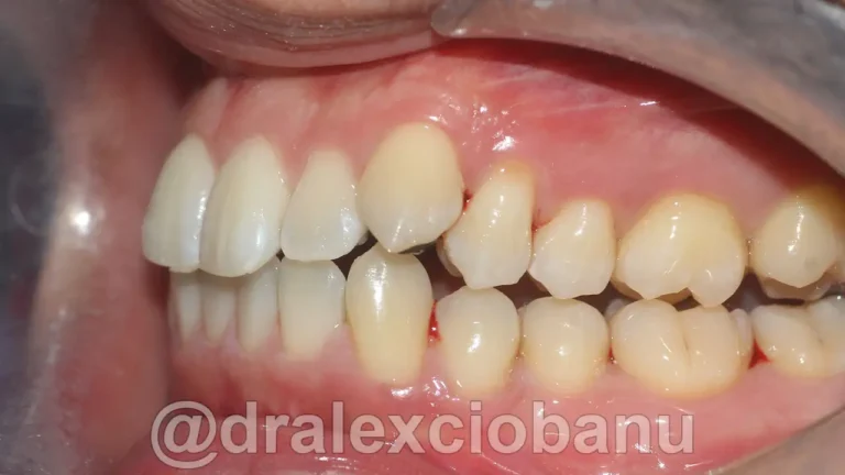 Caso-clinico-Affolamento-Dentale-2-Prima