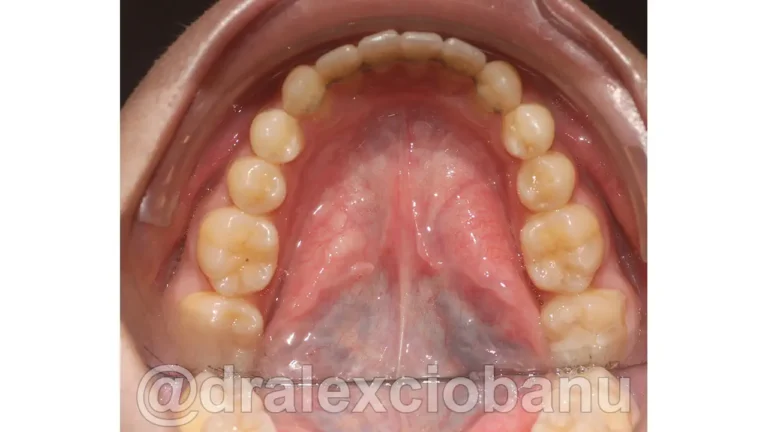 Caso-clinico-Affolamento-Dentale-3-Dopo