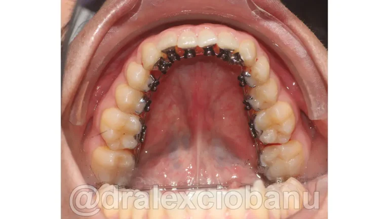 Caso-clinico-Affolamento-Dentale-3-Prima