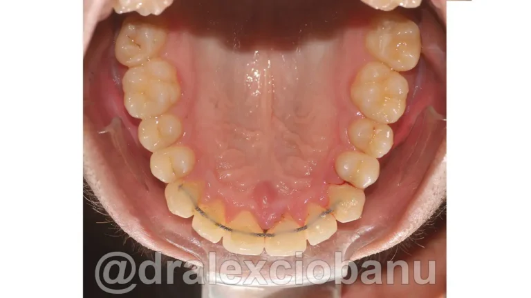 Caso-clinico-Affolamento-Dentale-4-Dopo