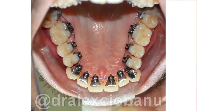 Caso-clinico-Affolamento-Dentale-4-Prima