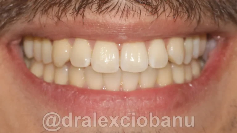 Caso-clinico-Affolamento-Dentale-5-Dopo