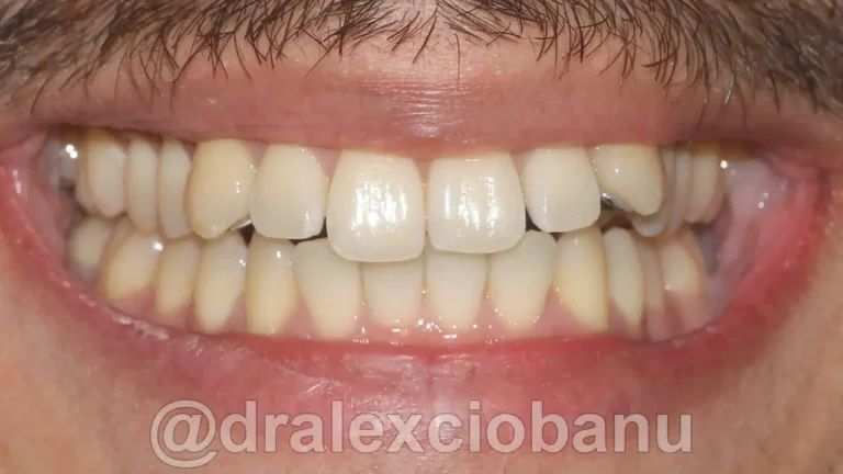 Caso-clinico-Affolamento-Dentale-5-Prima