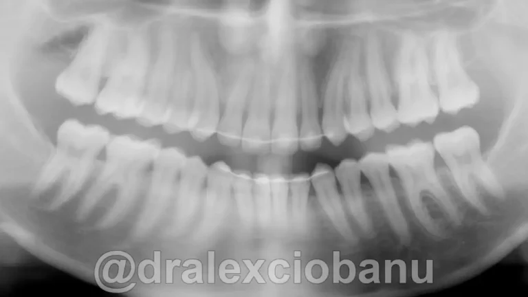 Caso-clinico-Affolamento-Dentale6-Dopo