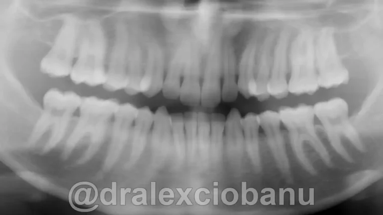 Caso-clinico-Affolamento-Dentale6-Prima