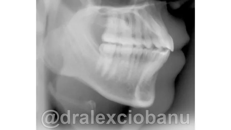 Caso-clinico-Affolamento-Dentale7-Dopo