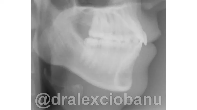 Caso-clinico-Affolamento-Dentale7-Prima