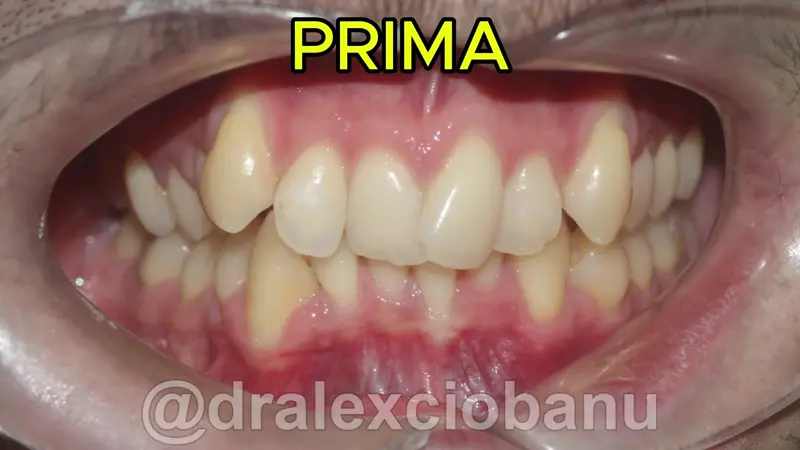 Caso clinico Affolamento dentale Prima - Dopo