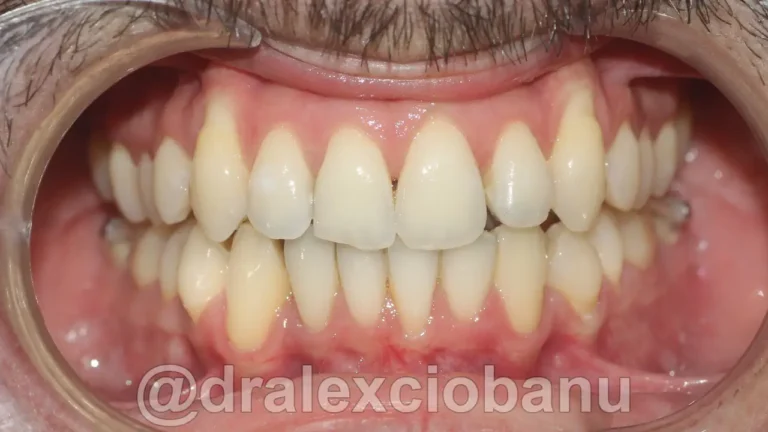 Caso clinico Affolamento dentale dopo