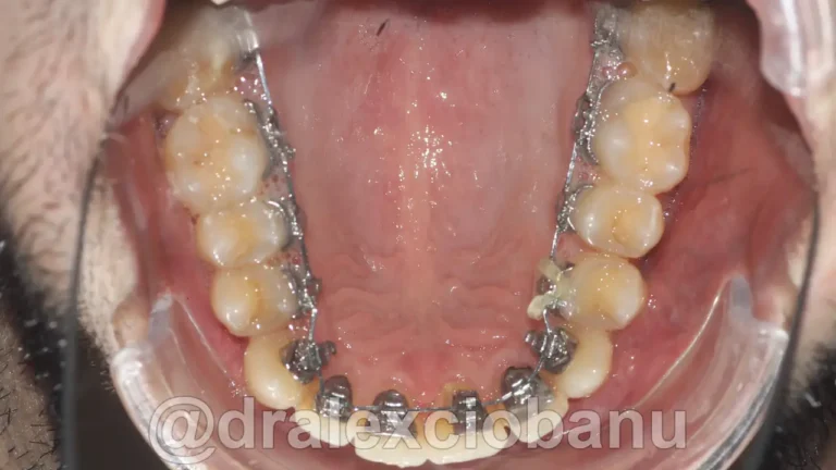 Caso clinico Affolamento dentale dopo