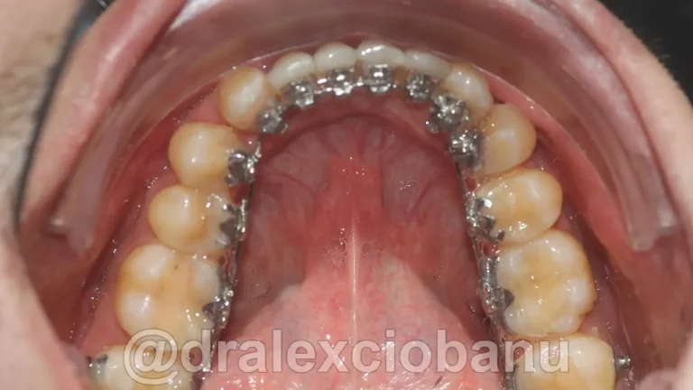 Caso clinico Affolamento dentale dopo 3