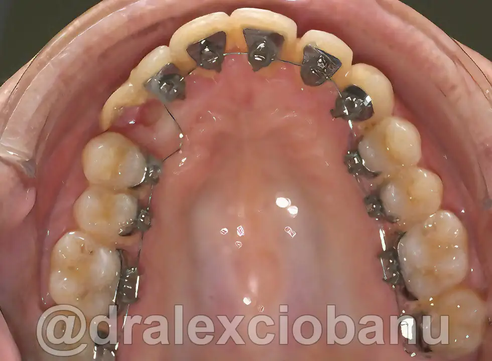 Caso clinico Canino incluso - DOPO