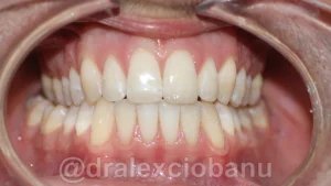 Caso clinico DIASTEMA dopo