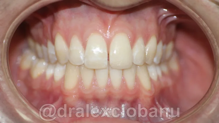 Caso clinico DIASTEMA - Prima 1
