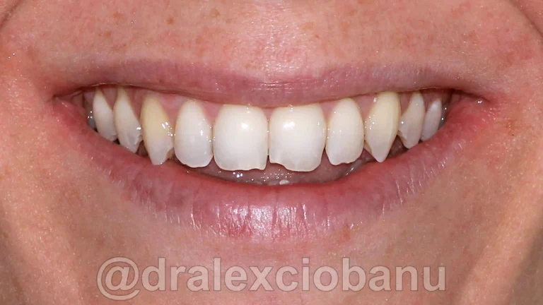 Caso clinico MORSO APERTO dopo