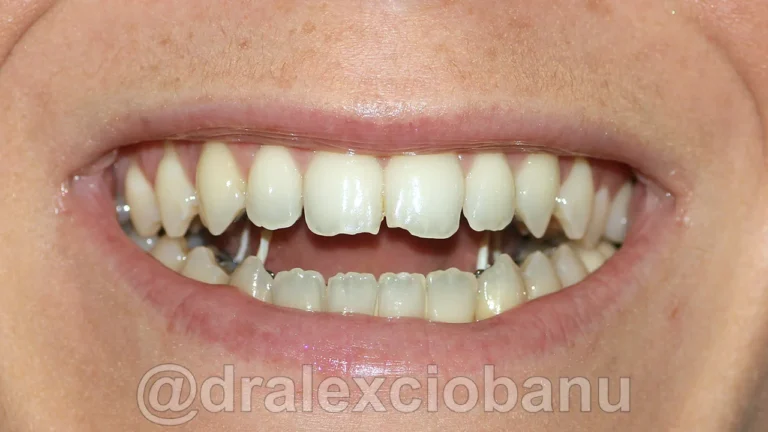 Caso clinico MORSO APERTO - Prima 1