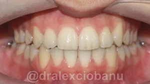 Caso clinico MORSO INCROCIATO dopo