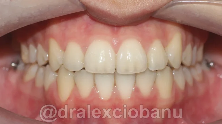 Caso clinico MORSO INCROCIATO dopo