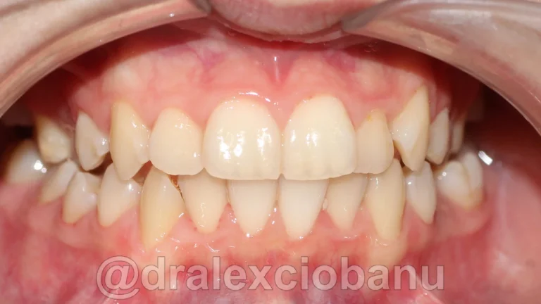 Caso clinico MORSO INCROCIATO Prima 1