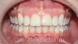 Caso clinico MORSO PROFONDO dopo