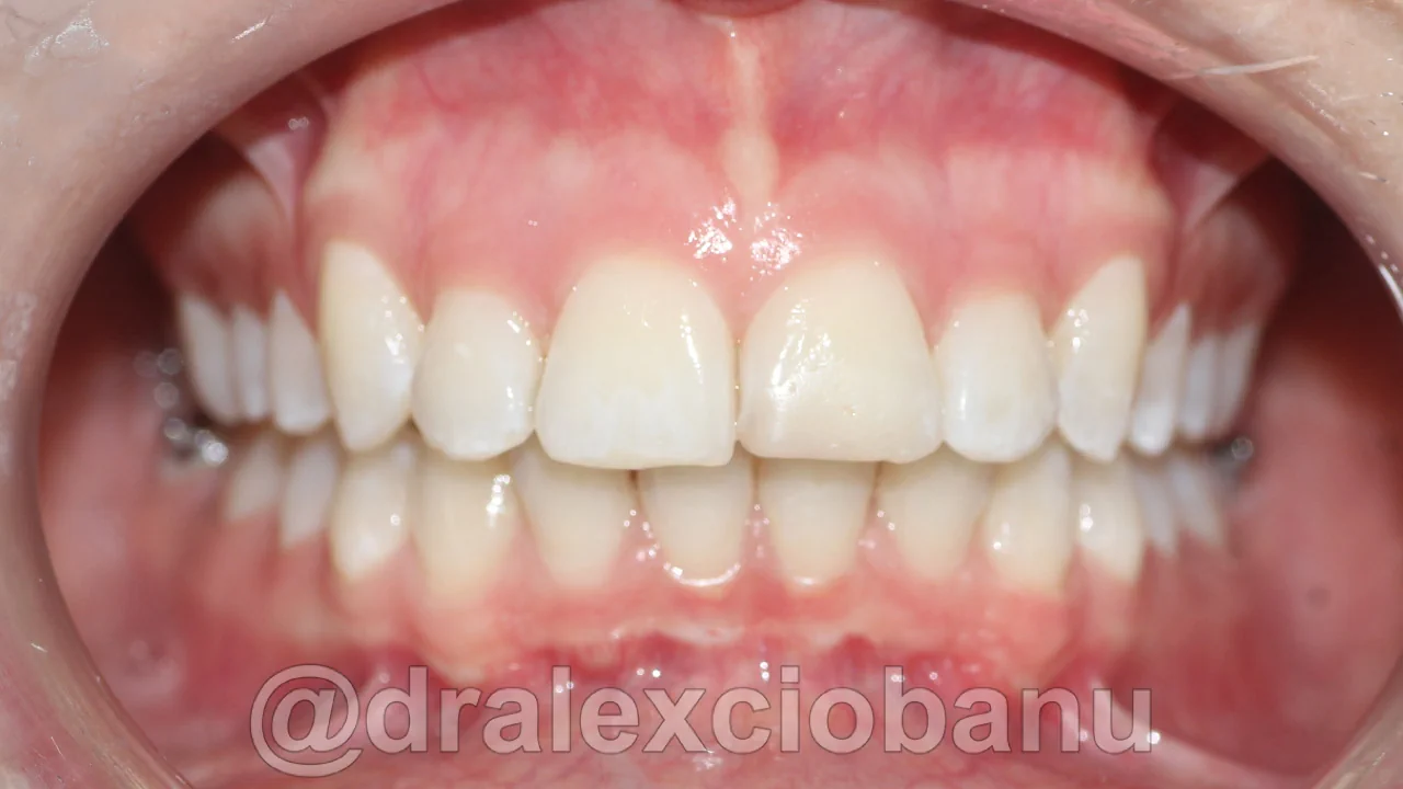 Caso clinico MORSO PROFONDO dopo