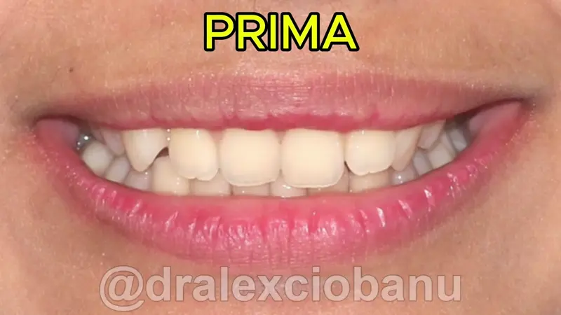 Caso clinico Morso Profondo - Prima - Dopo