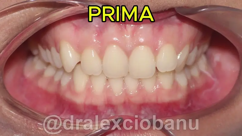 Caso clinico Morso Profondo - Prima - Dopo