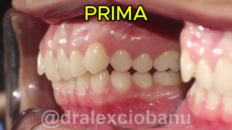 Caso clinico Morso Profondo - Prima - Dopo
