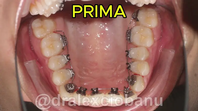 Caso clinico Morso Profondo - Prima - Dopo