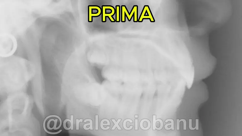 Caso clinico Morso Profondo - Prima - Dopo